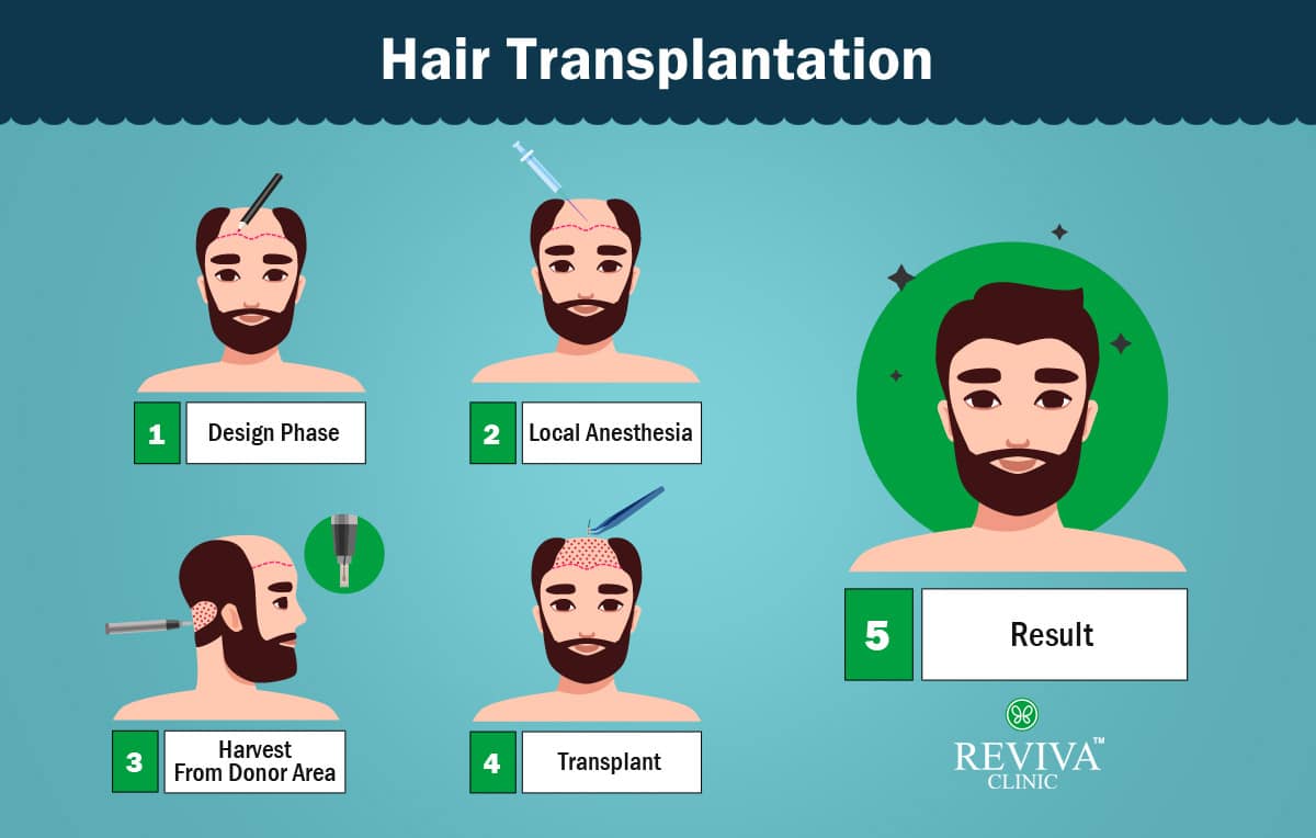 Hair Loss Lebanon